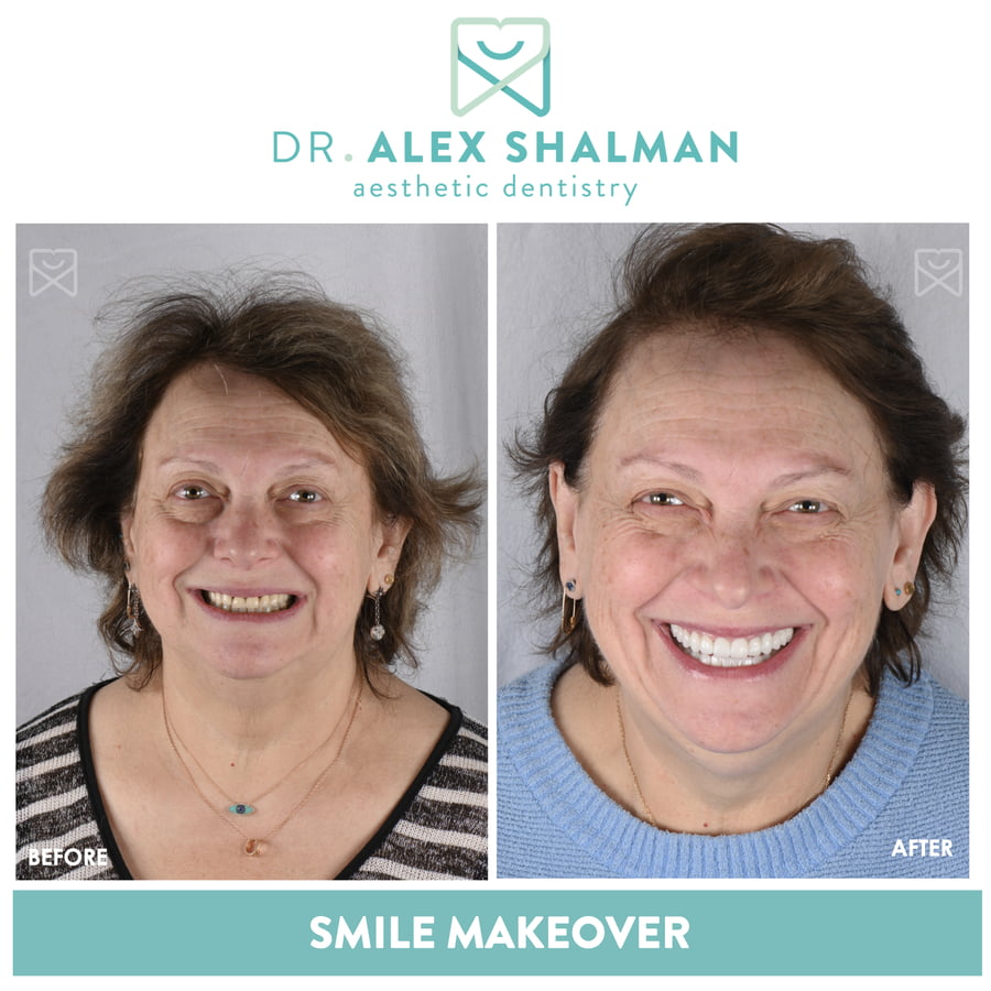 48. Smile Makeover - Full Mouth Rehab, Veneers, Crowns, Onlays, Implants
