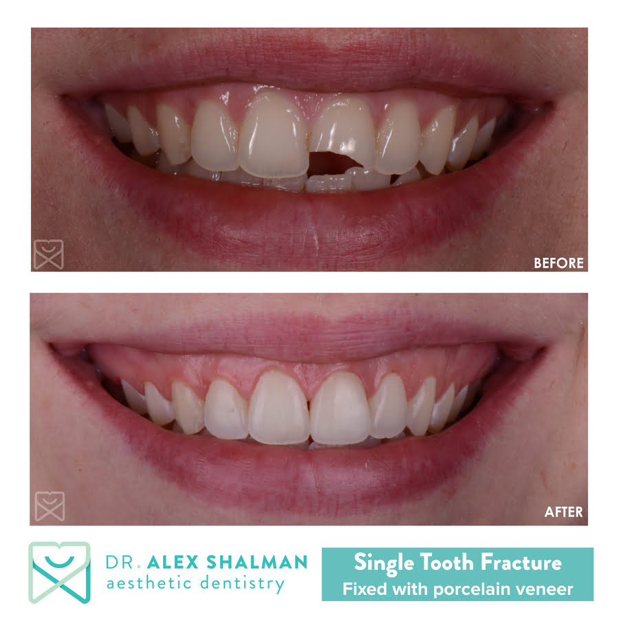 Broken Tooth Before and After