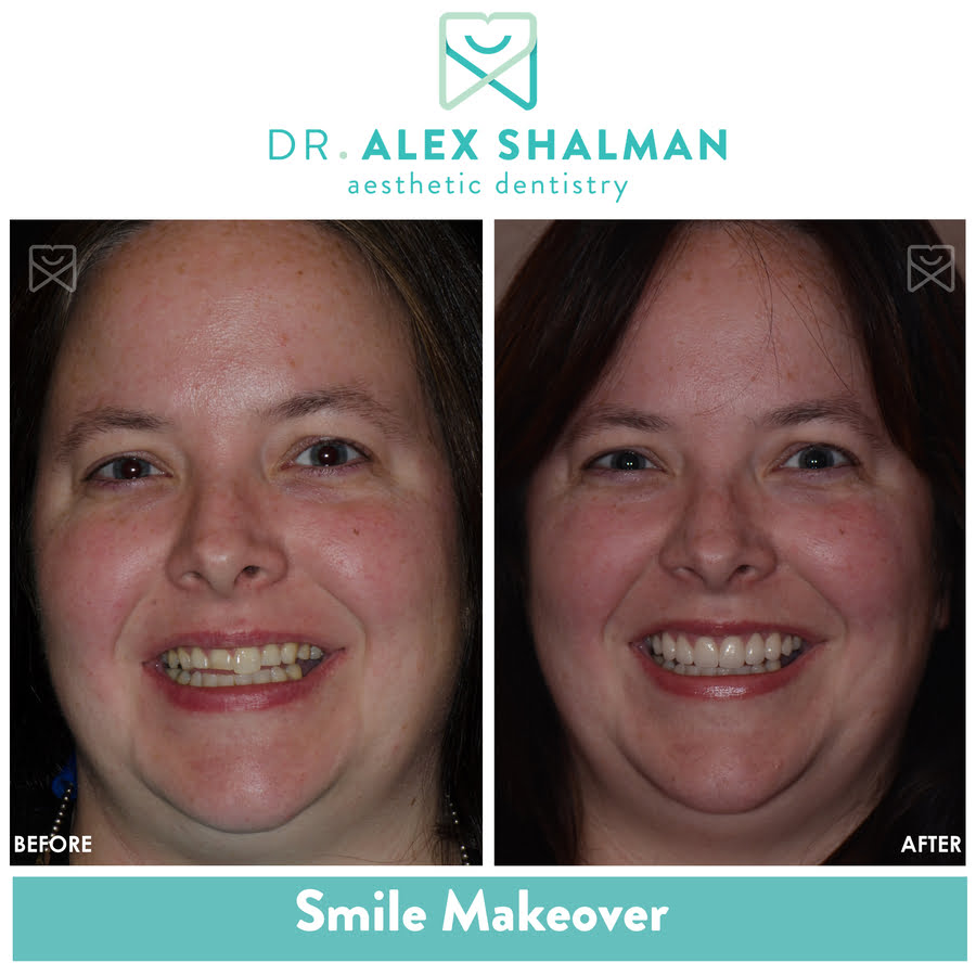 Invisalign Teeth Straightening Before and After