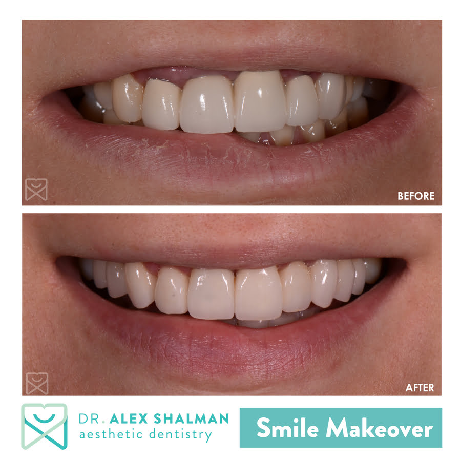 Smile Makeover Crowns