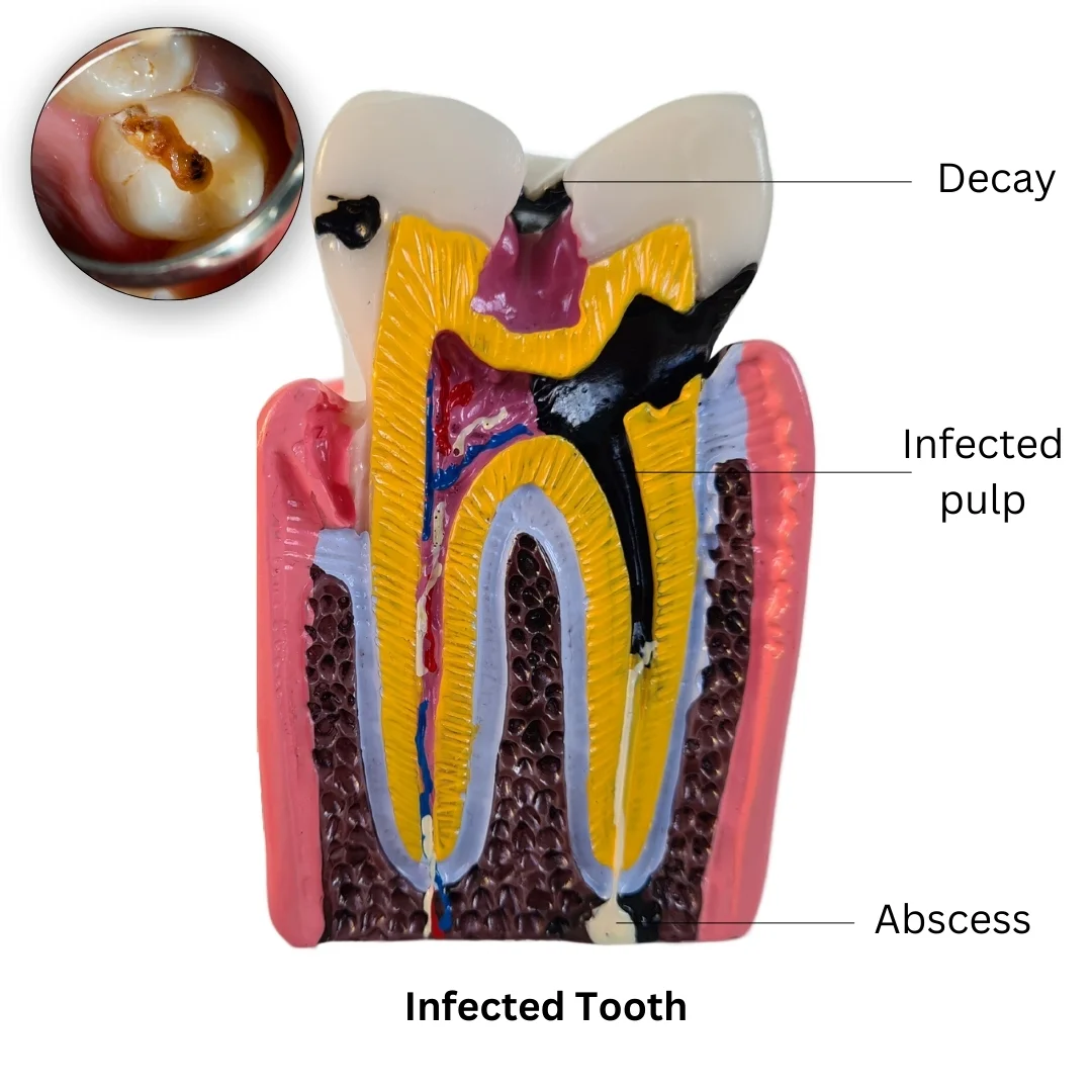Infected Tooth