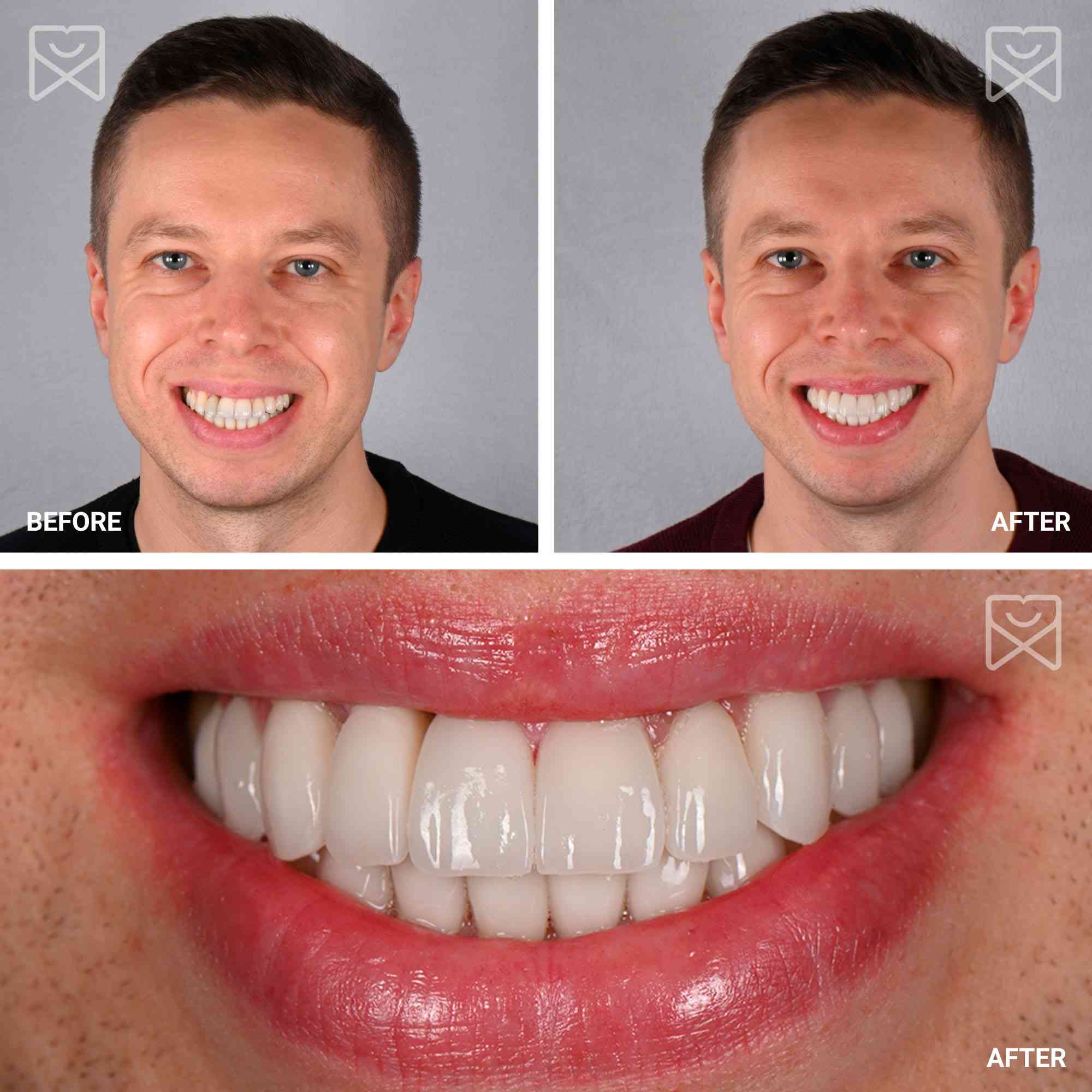 18 Tooth Smile Makeover Before After