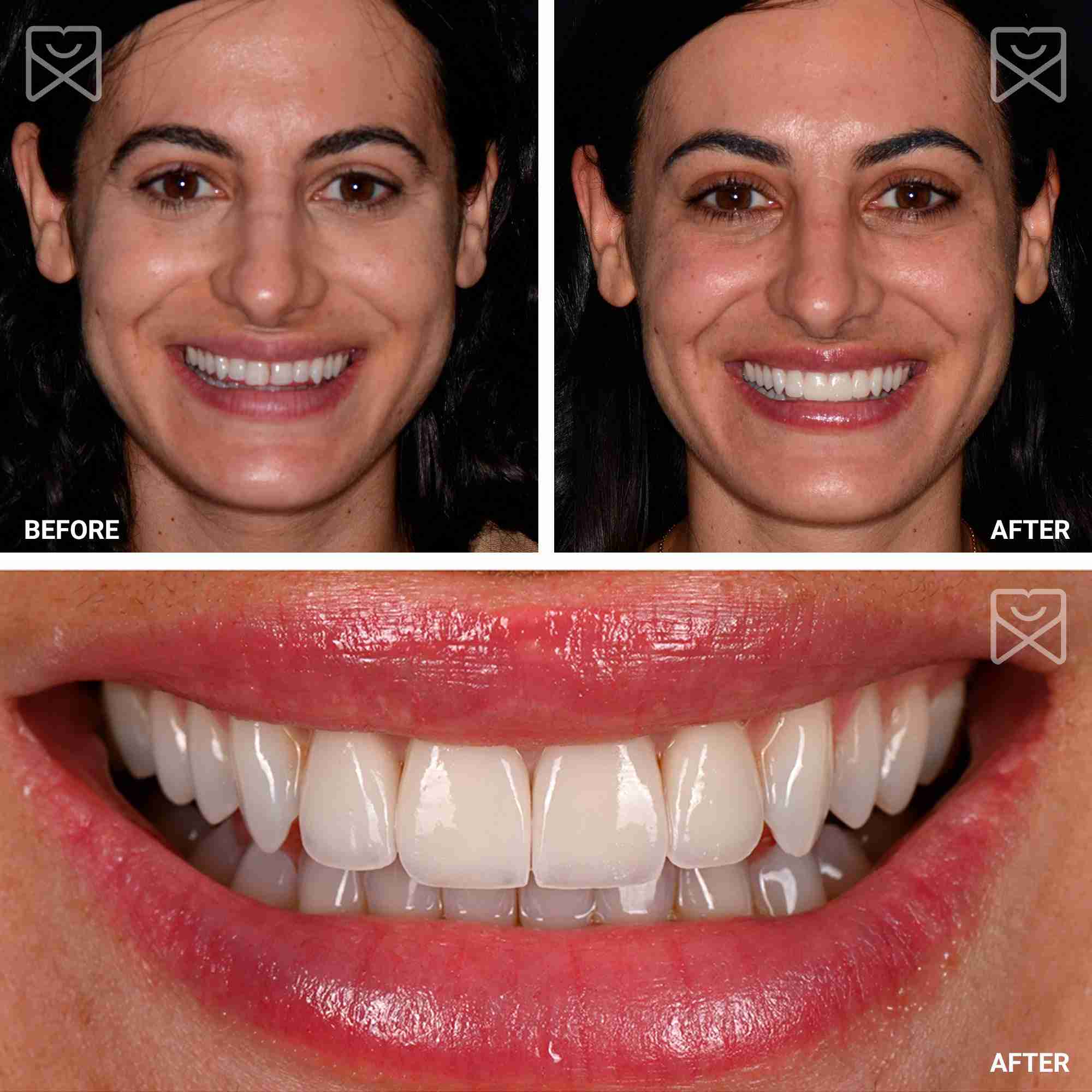Four Tooth Smile Makeover Before After