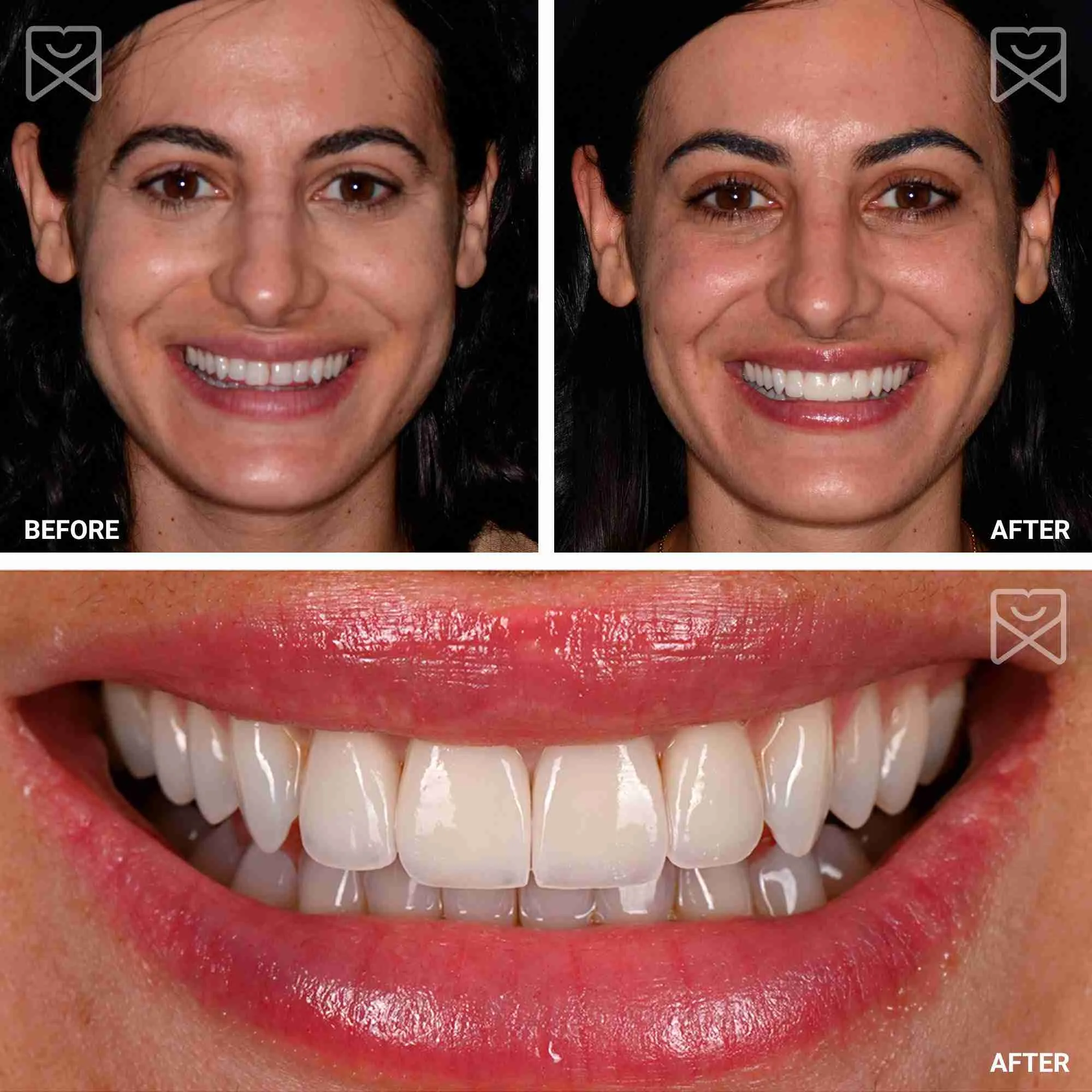 Four Tooth Smile Makeover Before After