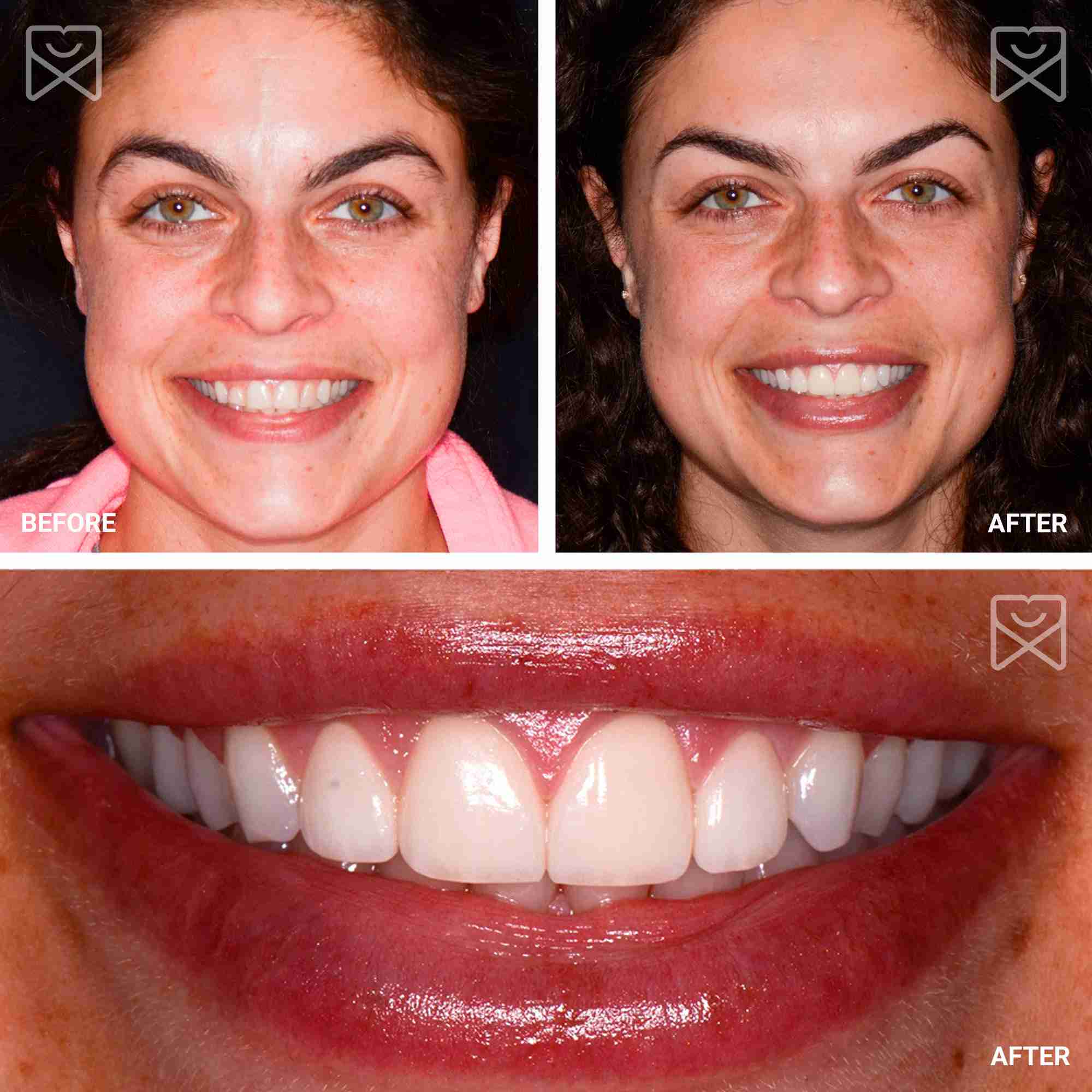 Four Veneers Before After