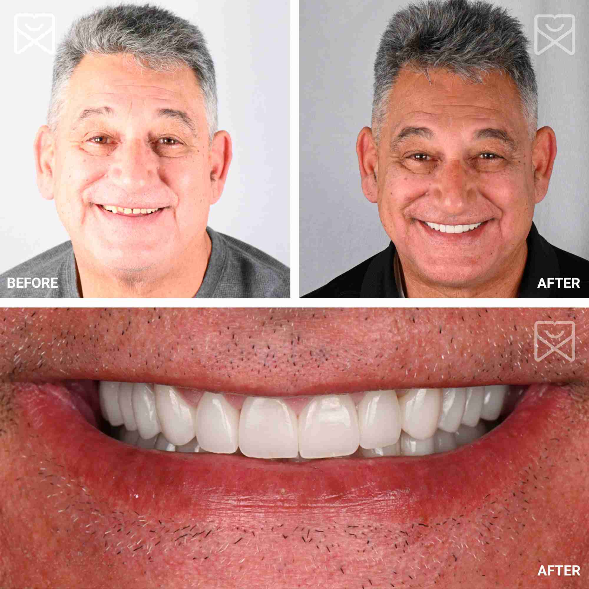 Full Mouth Rehab Age Reversing Before After