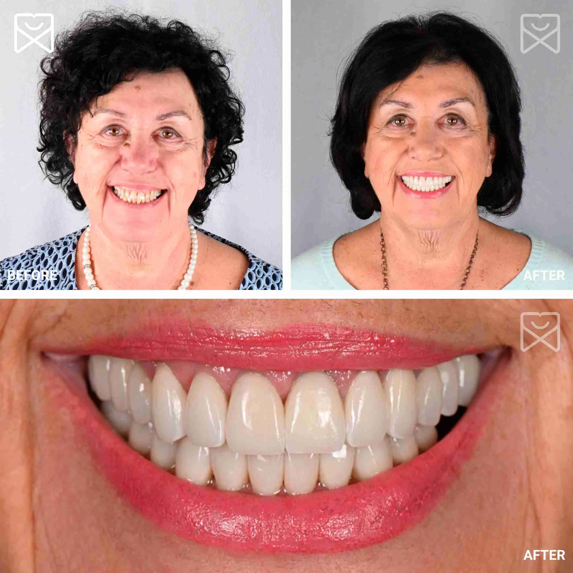 Full Mouth Rehab Before After