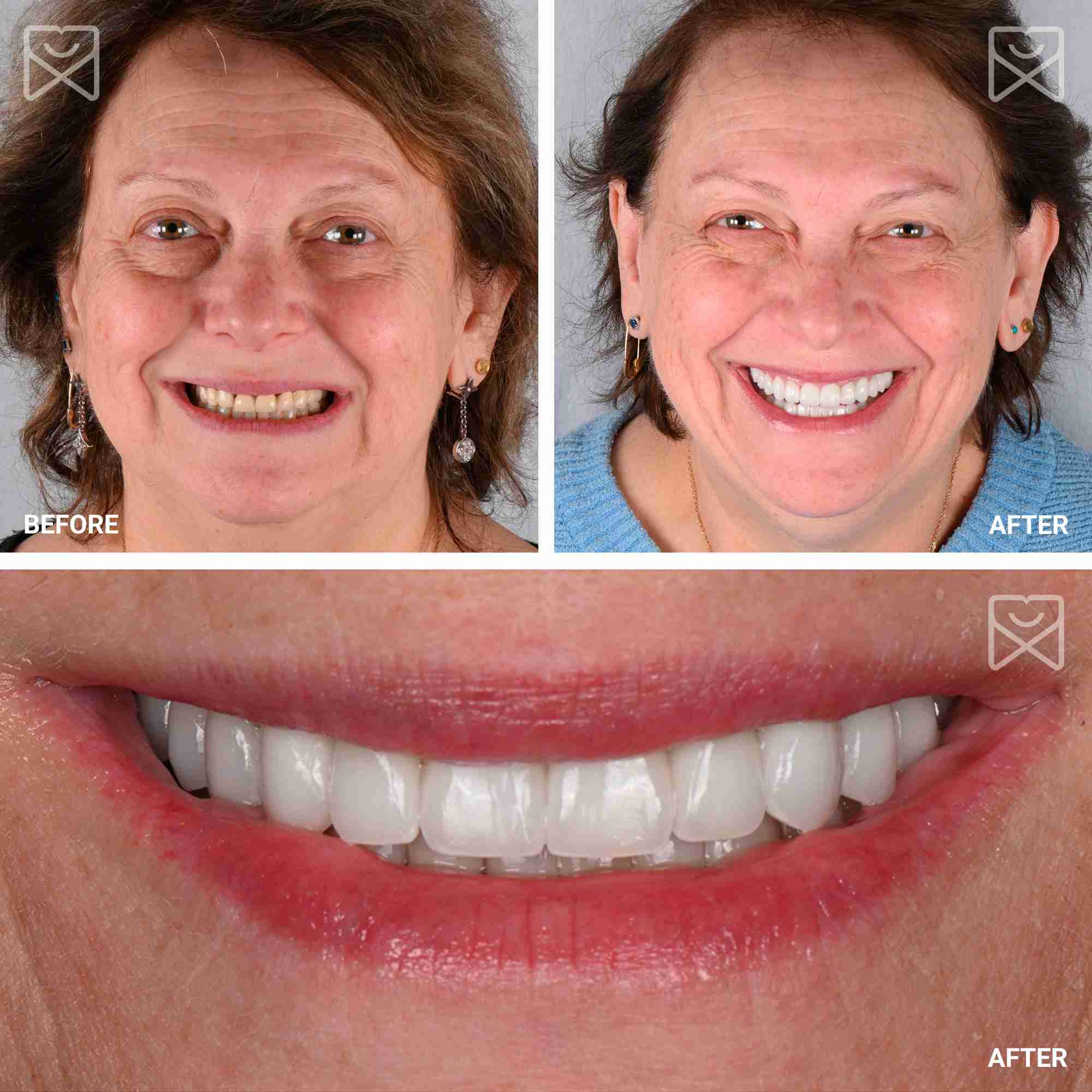 Full Mouth Smile Makeover Before After-1