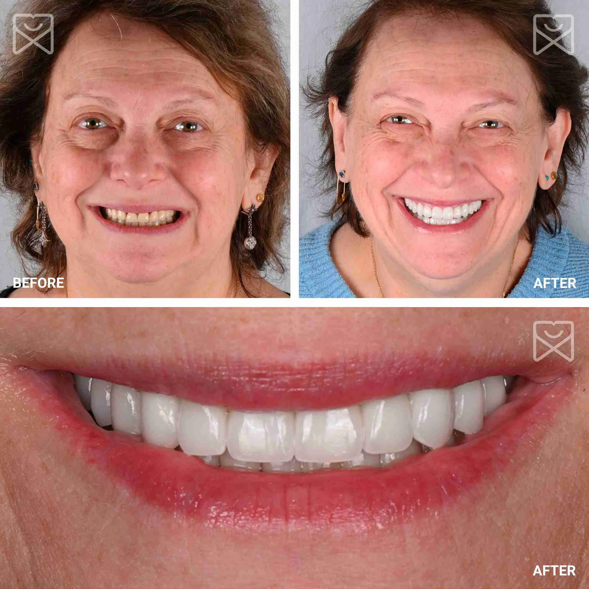 Full Mouth Smile Makeover Before After-1