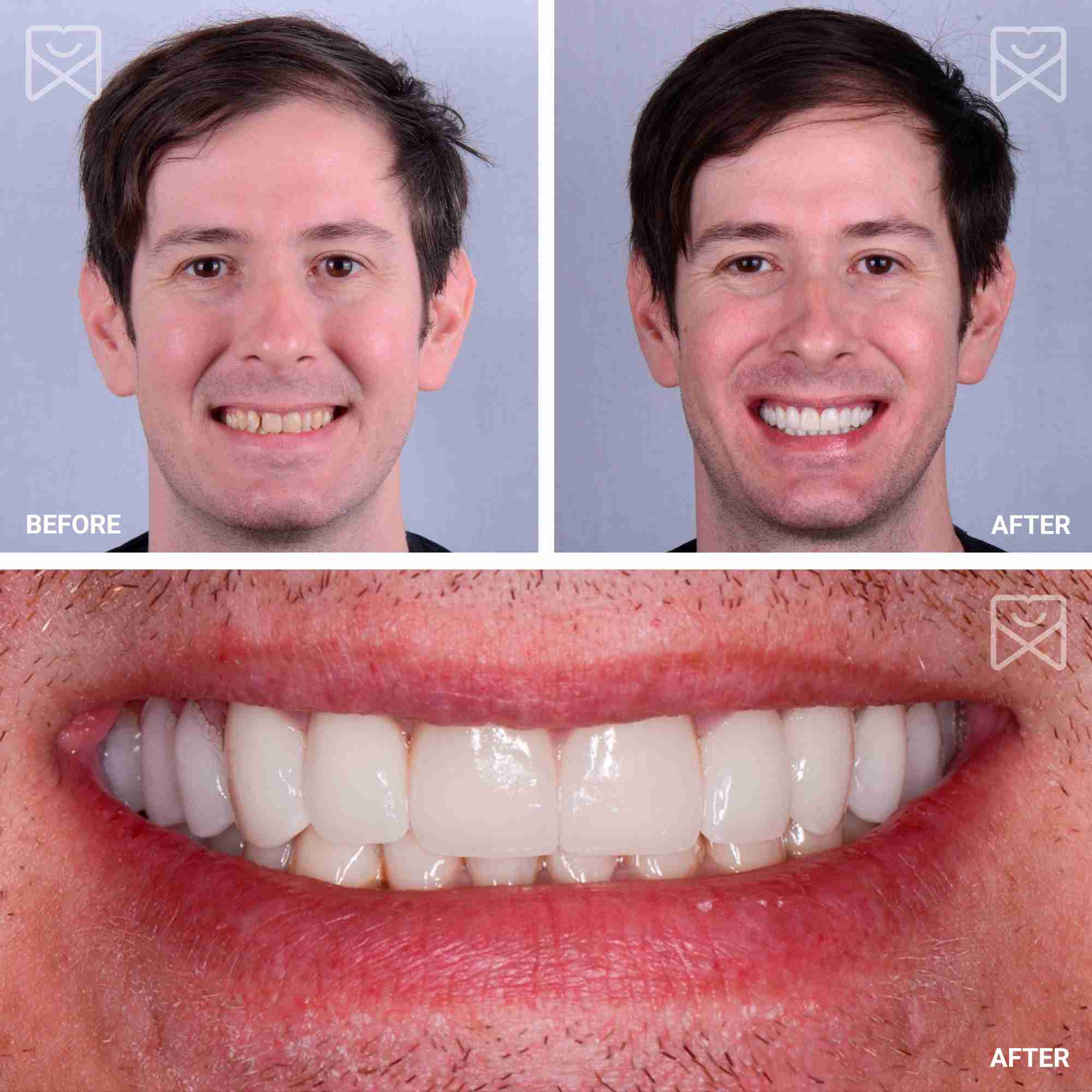 Full Mouth Smile Makeover Before After