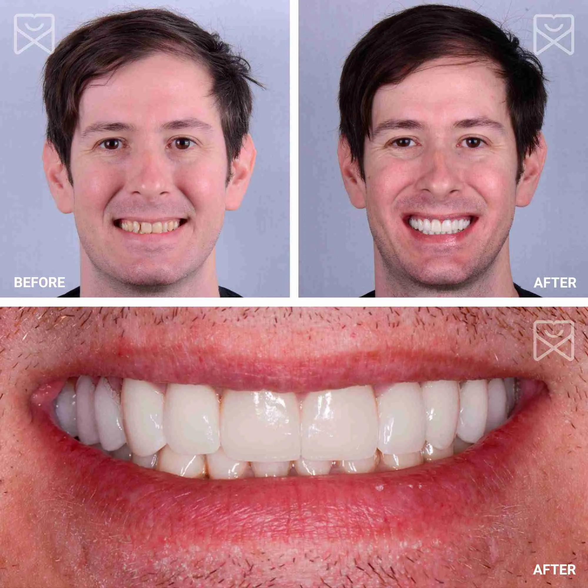 https://www.shalmandentistry.com/wp-content/uploads/2025/04/Full-Mouth-Smile-Makeover-Before-After.jpg.webp?utm_source=chatgpt.com