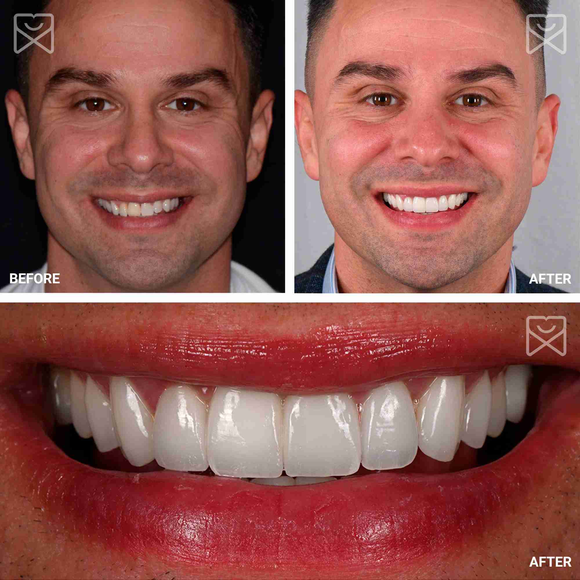 Smile Makeover Before After