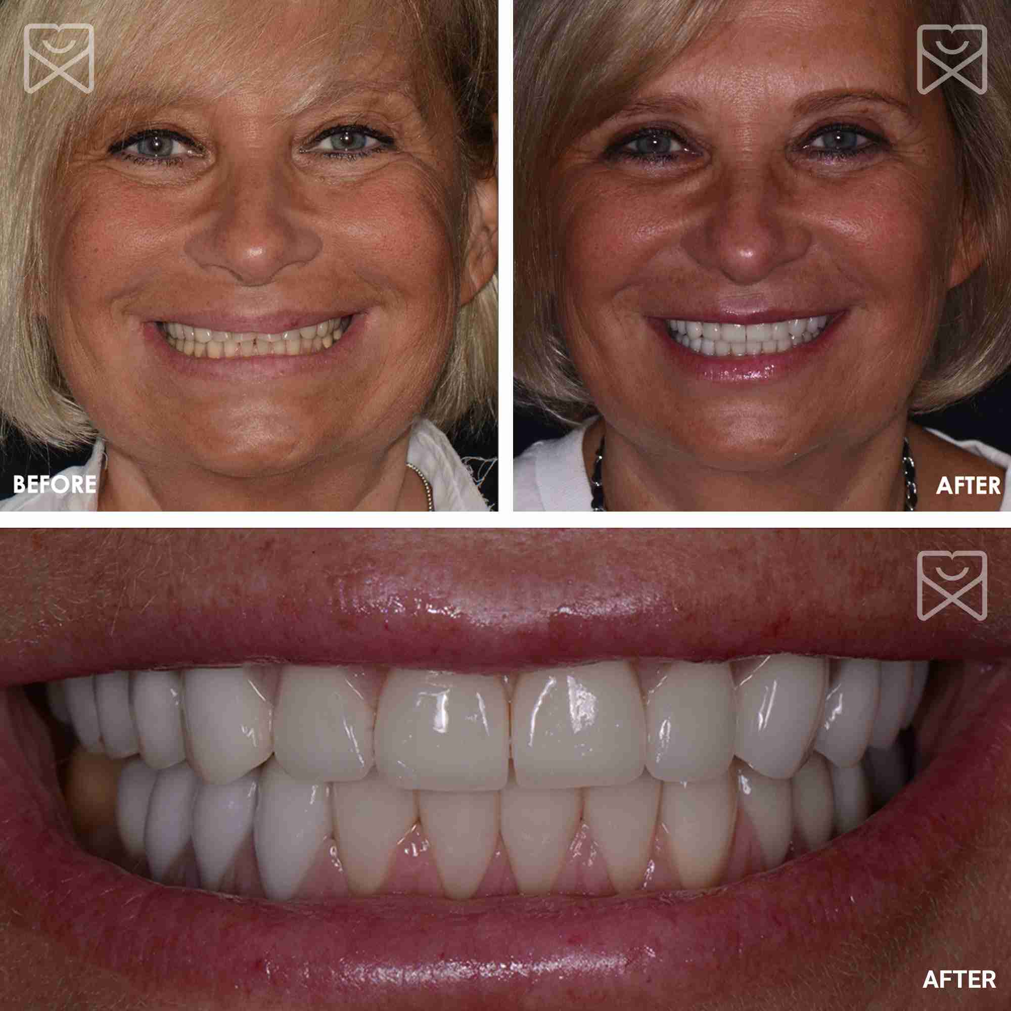 Smile Makeover Full Mouth Before After
