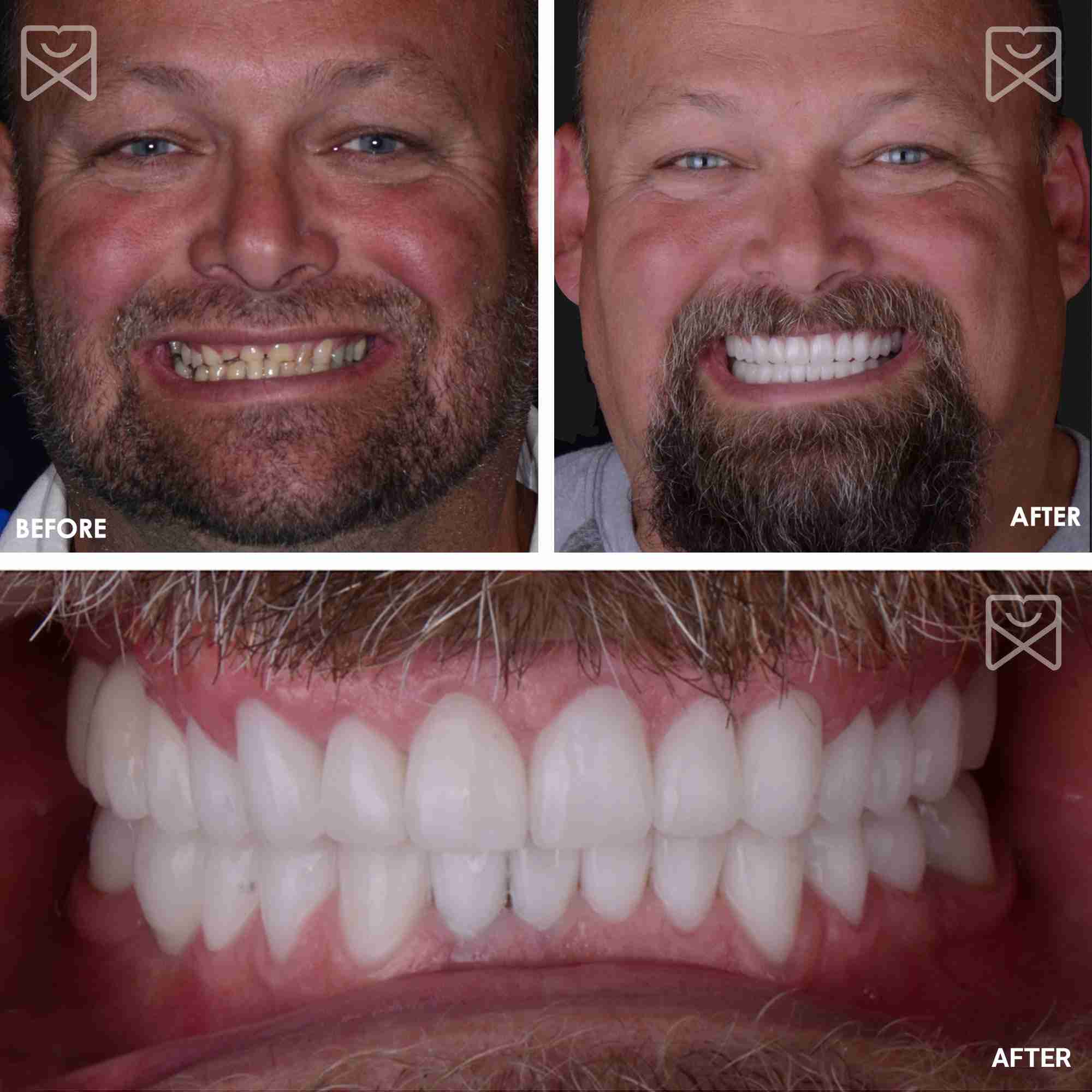 Smile Makeover Full Mouth Rehab Before After