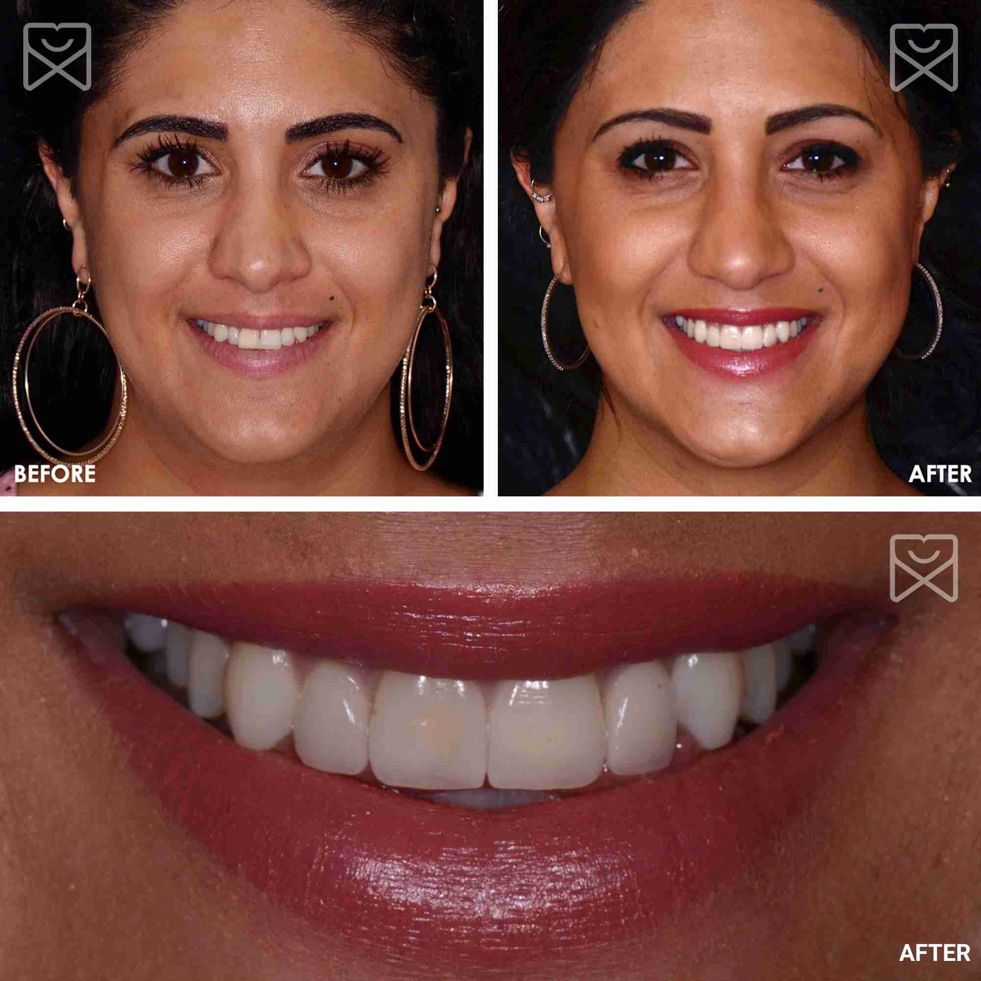 Smile Makeover Veneer Before After 1