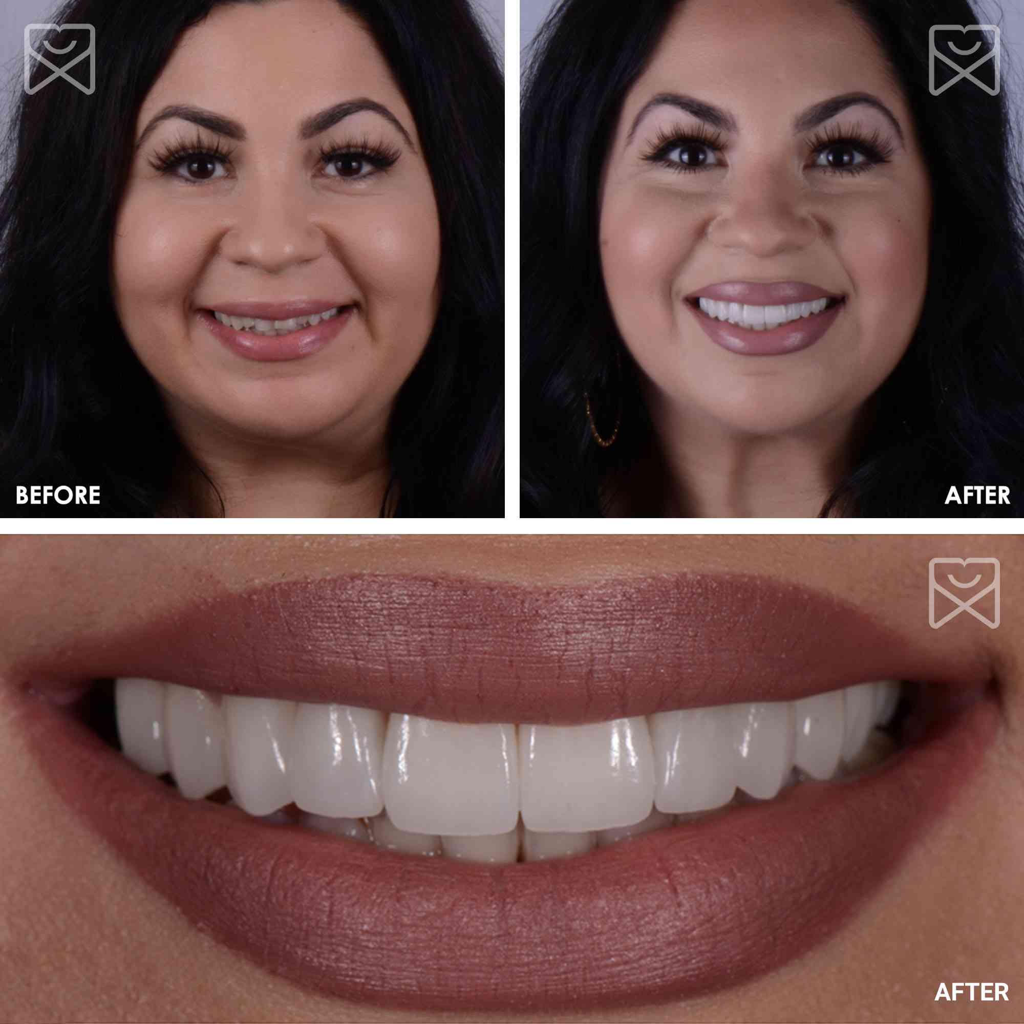 Smile Makeover Veneer Before After