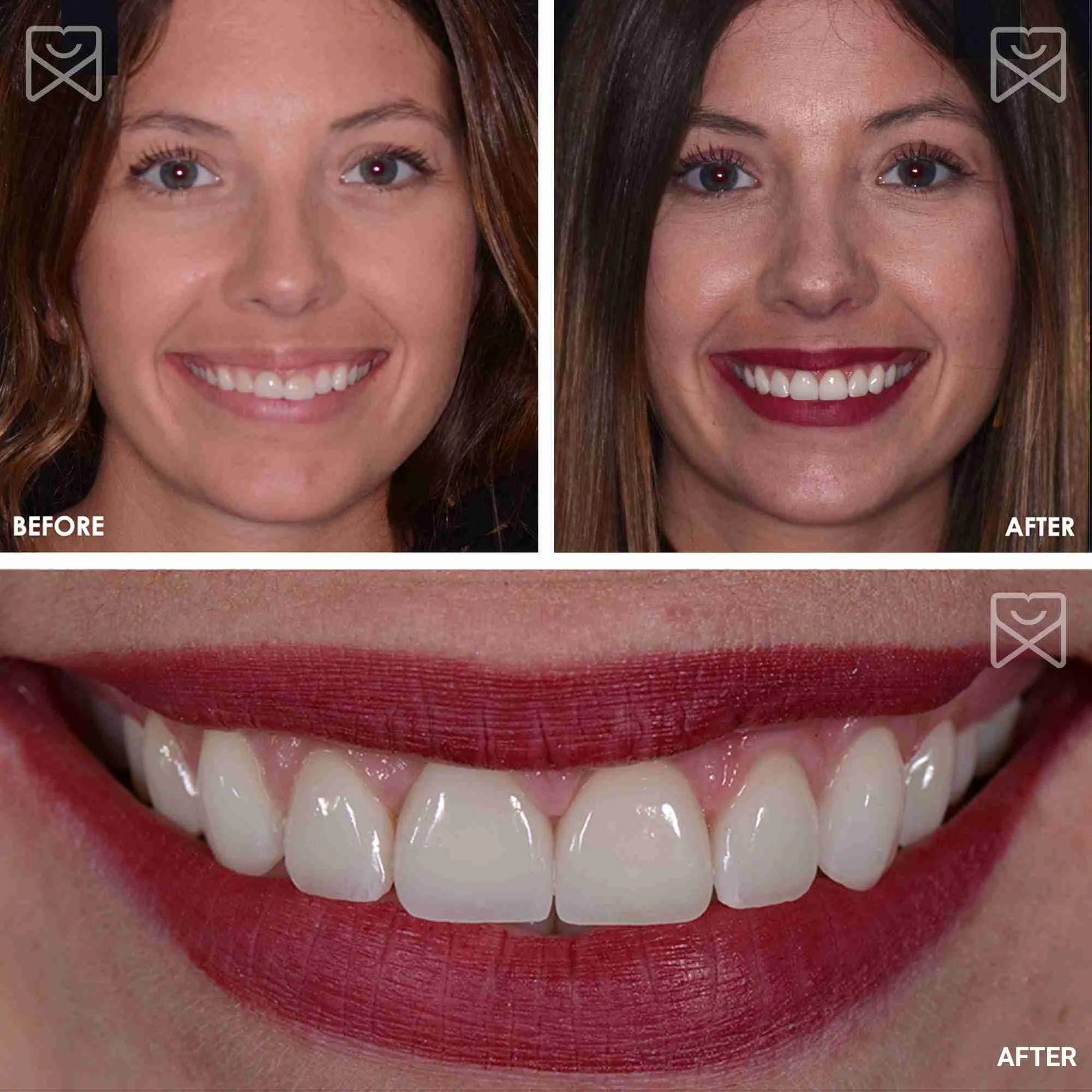 Smile Makeover Veneer Gingival Laser Before After