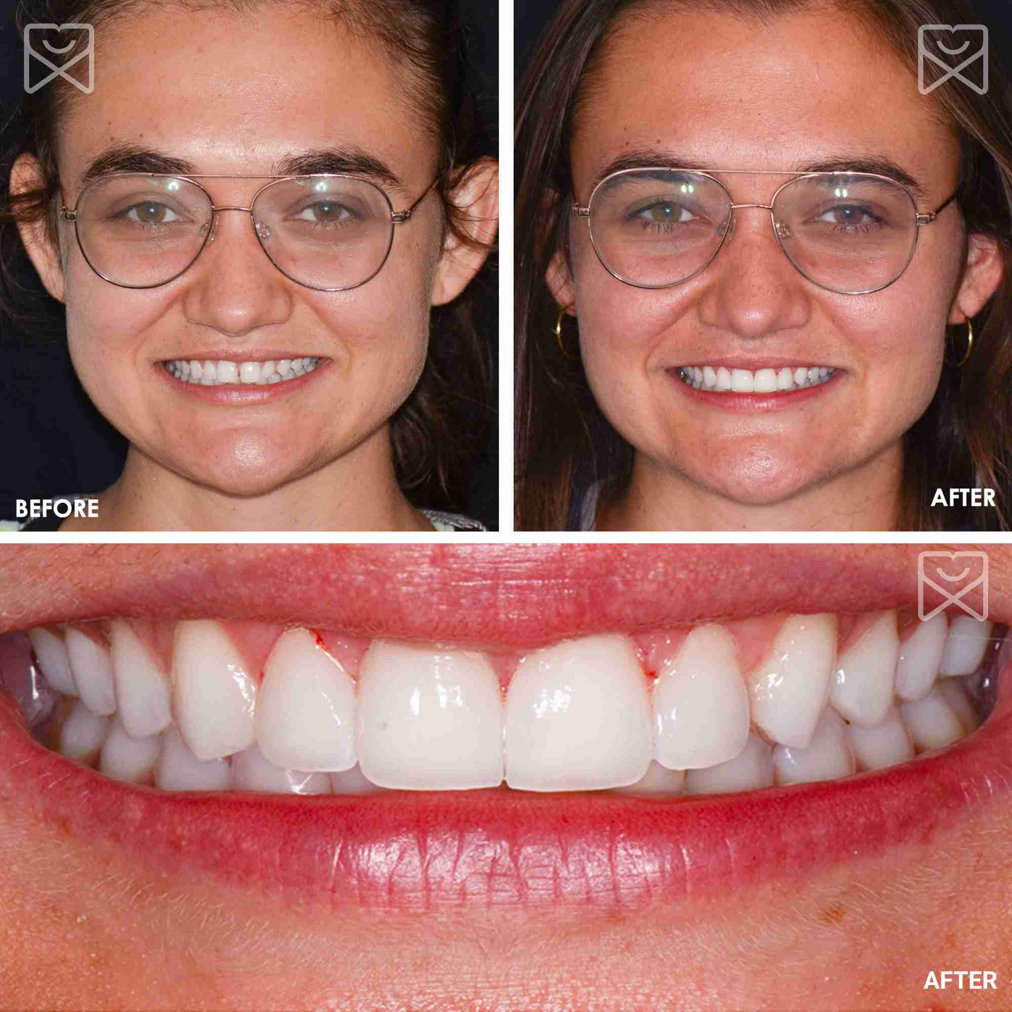 Smile Makeover Veneers Before After 2