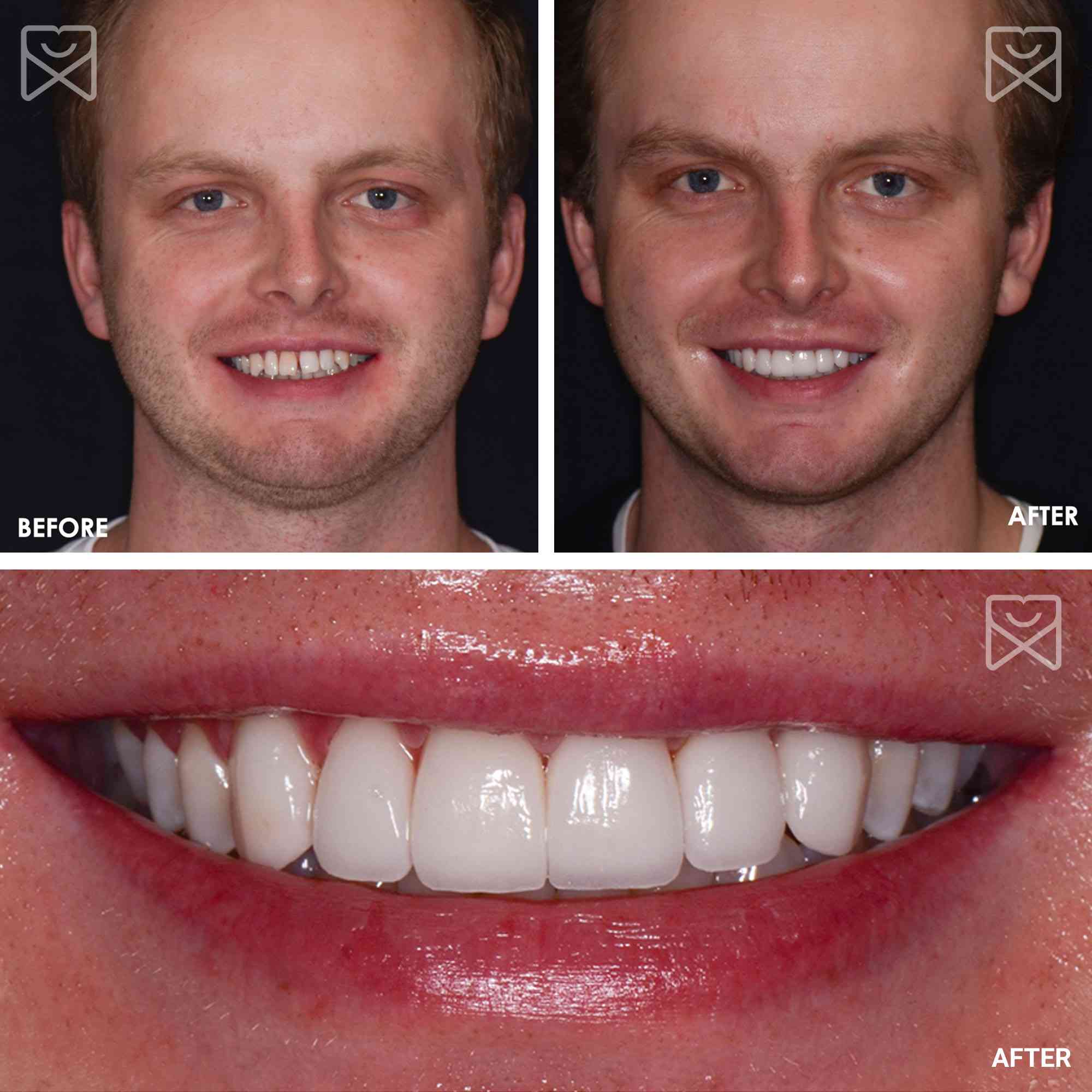 Smile Makeover Veneers Before After 3