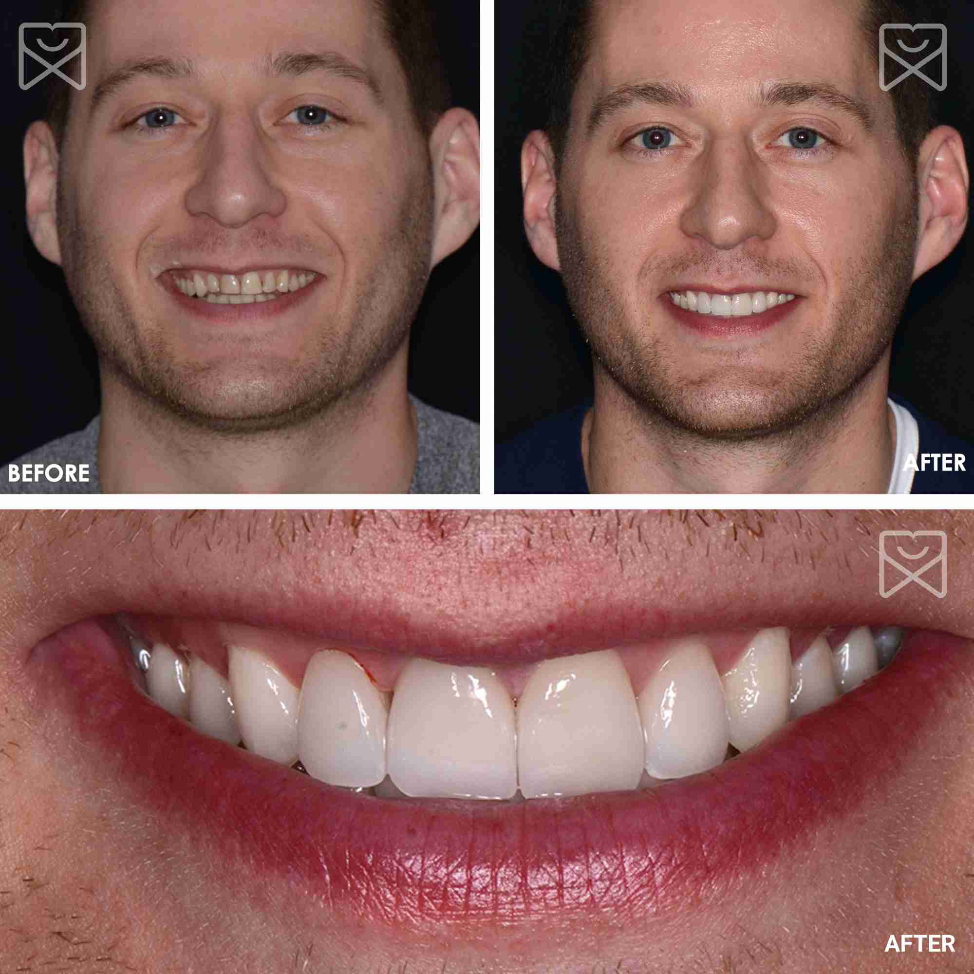 Smile Makeover Veneers Before After 4