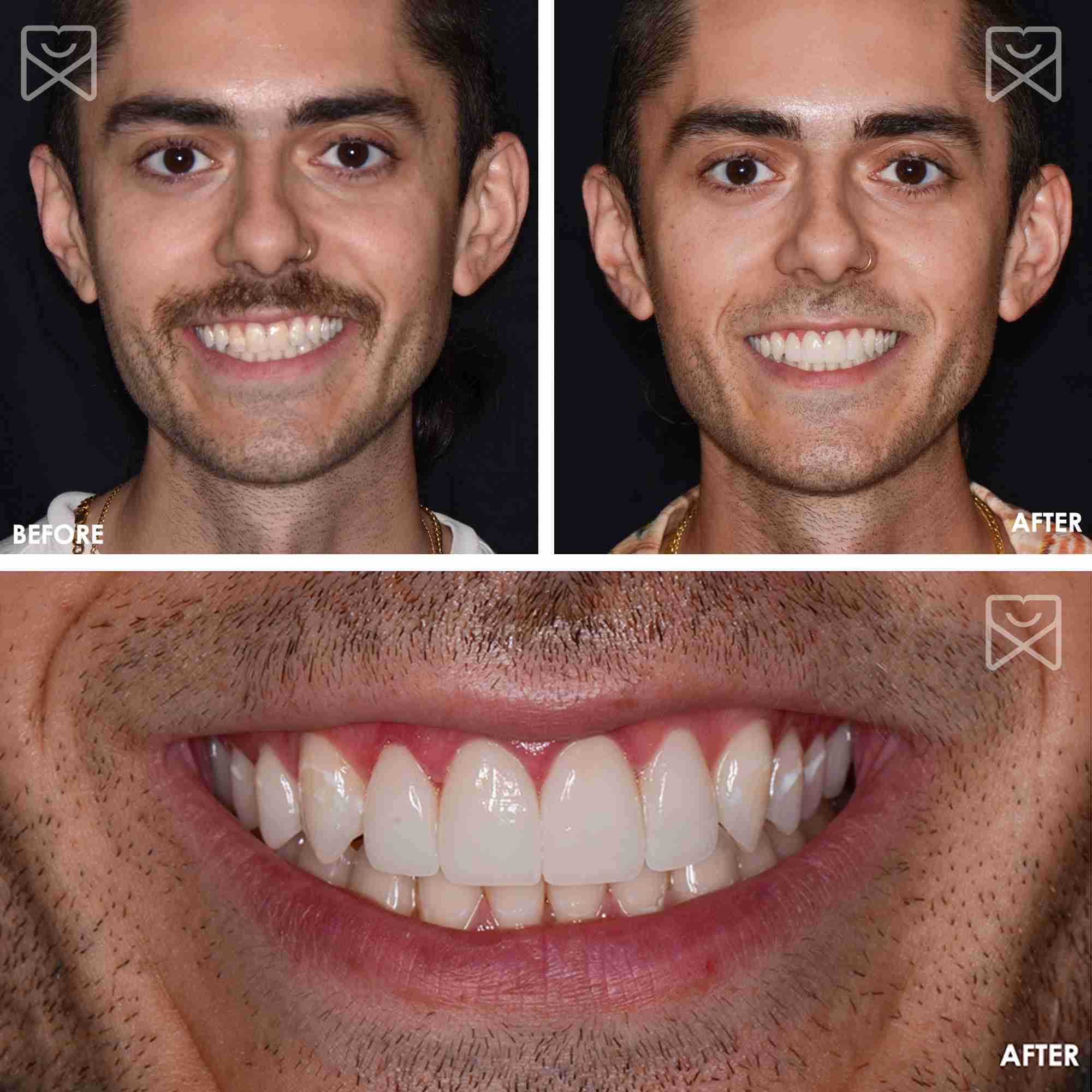 Smile Makeover Veneers Before After 5