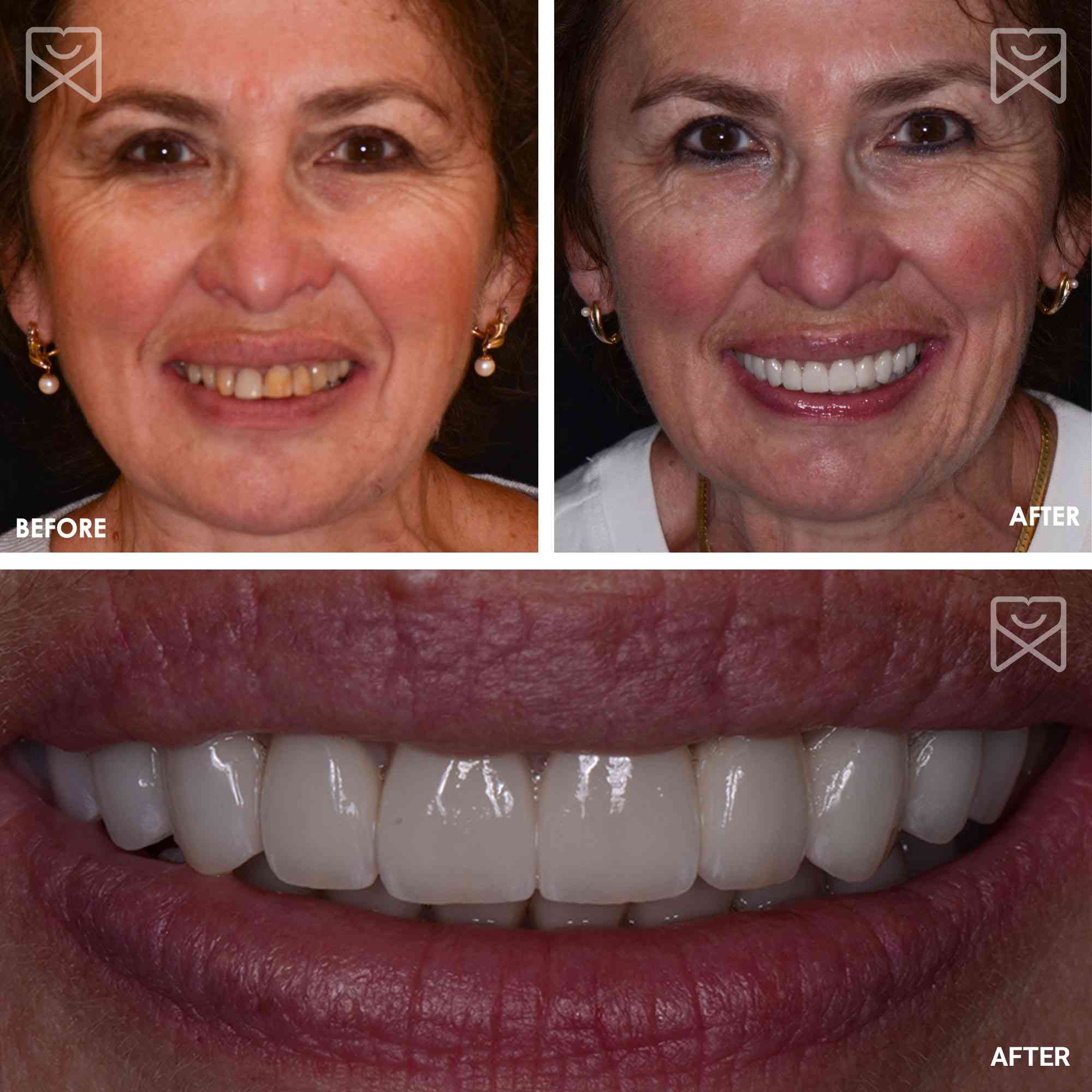 Smile Makeover Veneers Crowns Implants Before After
