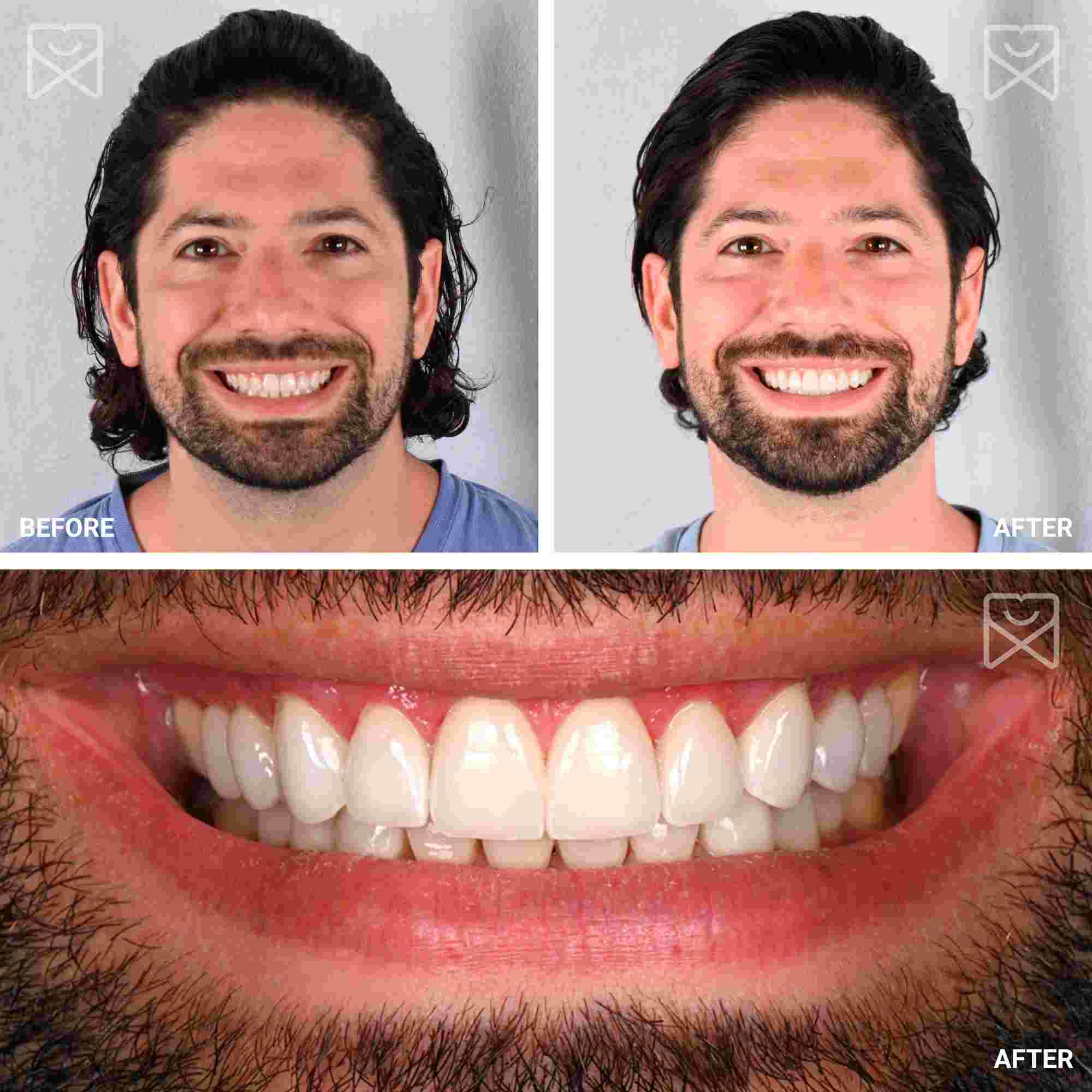 Twenty Veneer Smile Makeover Before After