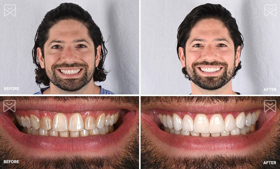 Cosmetic Dentistry Before and After